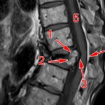 Fraktur Wirbelkörper BWK12 – Untersuchung Radiologie