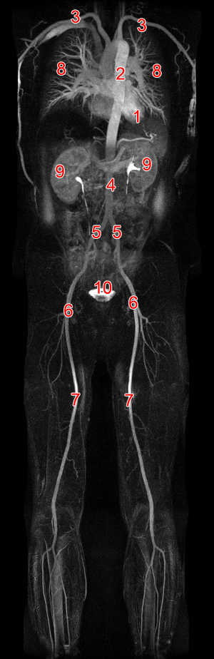 Ausschluss Aortenaneurysma in der Radiologie