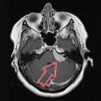 Akustikusneurinom | Offenes MRT Berlin